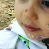 Двухлетняя девочка получила в садике увечья: у ребенка синяки на ушах и ссадины на лице. Фото