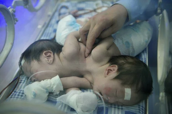 Индийские врачи не могут определить пол новорожденных сиамских близнецов