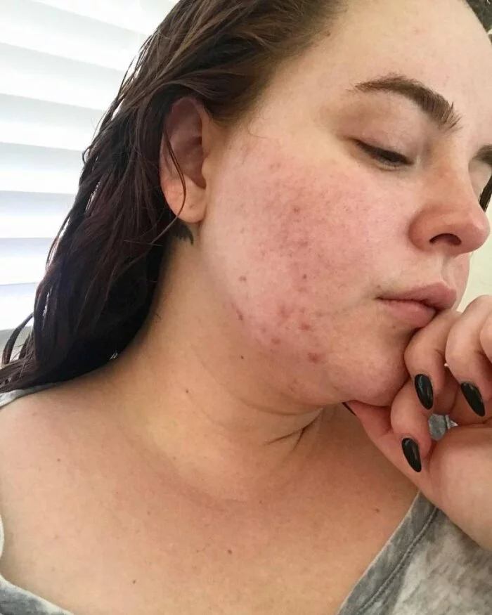 Модель Тесс Холидей опубликовала фото с угревой сыпью на лице